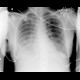 ARDS, interstitial edema: X-ray - Plain radiograph